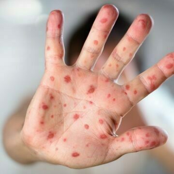 Casos da síndrome mão-pé-boca são registrados em escolas de Tubarão