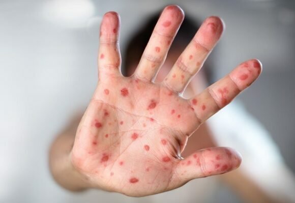 Casos da síndrome mão-pé-boca são registrados em escolas de Tubarão