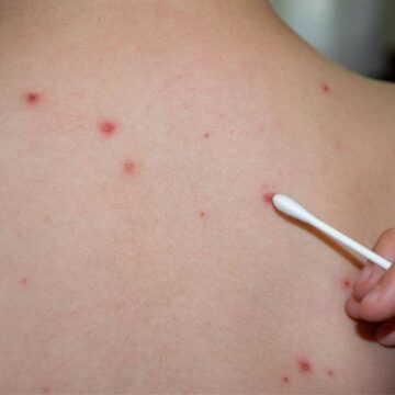 Caso de varíola dos macacos é registrado em Braço do Norte