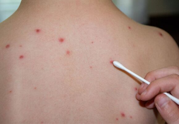 Caso de varíola dos macacos é registrado em Braço do Norte