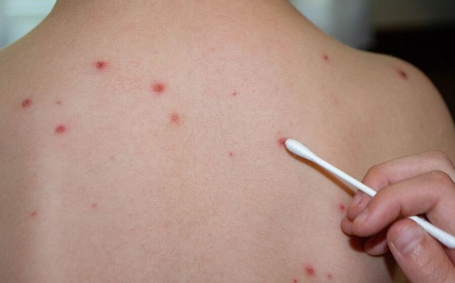 Caso de varíola dos macacos é registrado em Braço do Norte