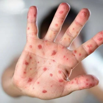 Gravatal: creches serão fechadas para higienização após casos de mão-pé-boca Gravatal: creches serão fechadas para higienização após casos de mão-pé-boca