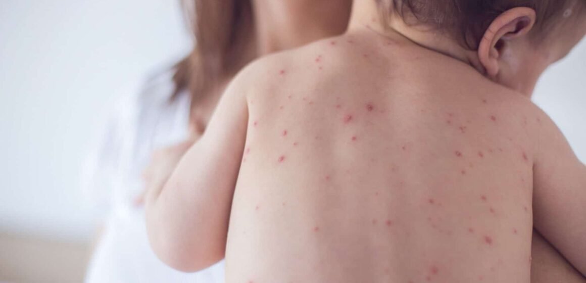 Vacinação contra o sarampo é antecipada em Tubarão